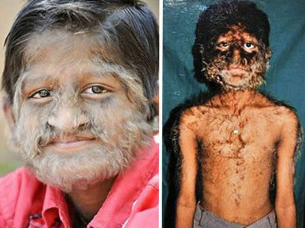 હાઇપરટ્રિકોસીસ