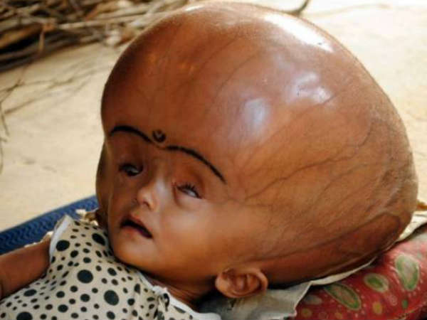 હાઇડ્રોસેફાલસ