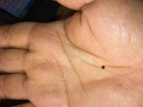 ડાબી હથેળીમાં તલ