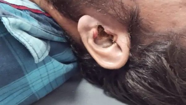 કાનમાંથી વહેવા લાગ્યુ લોહી